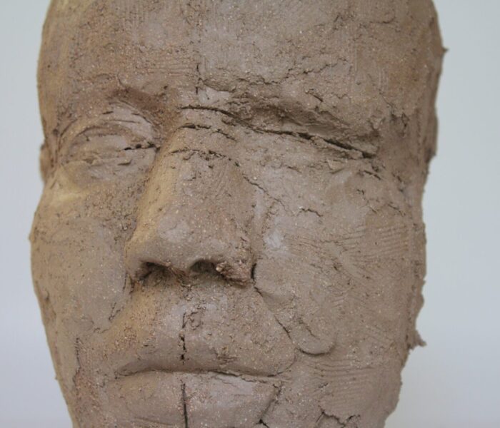 0114_35d) cheek philtrum, right side